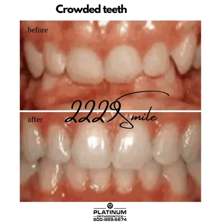 Before & after: Crowded Teeth