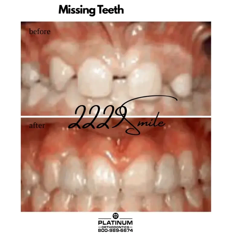 Before & after: Missing Teeth
