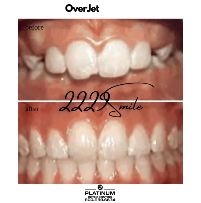 Before & after: Overjet