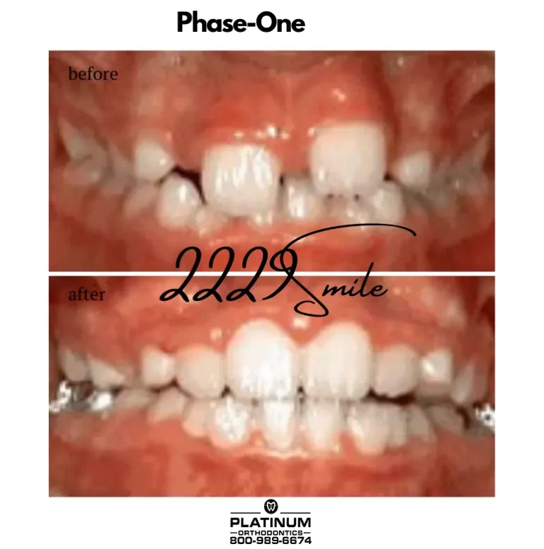 Before & after: Phase 1 (Early)