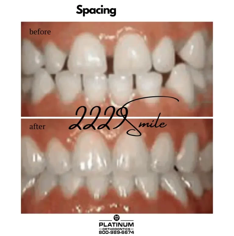 Before & after: Spacing