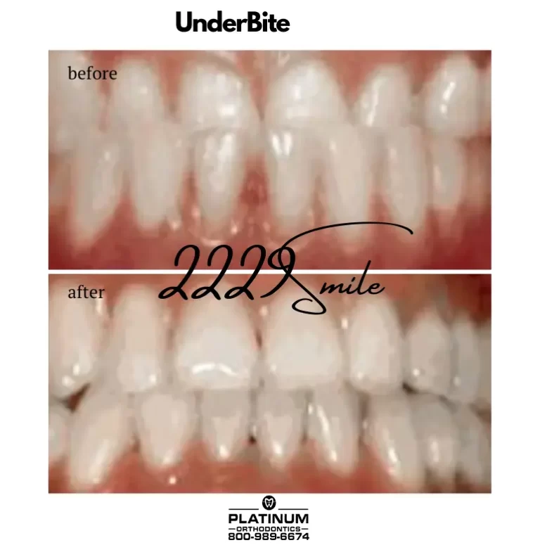 Before & after: Underbite